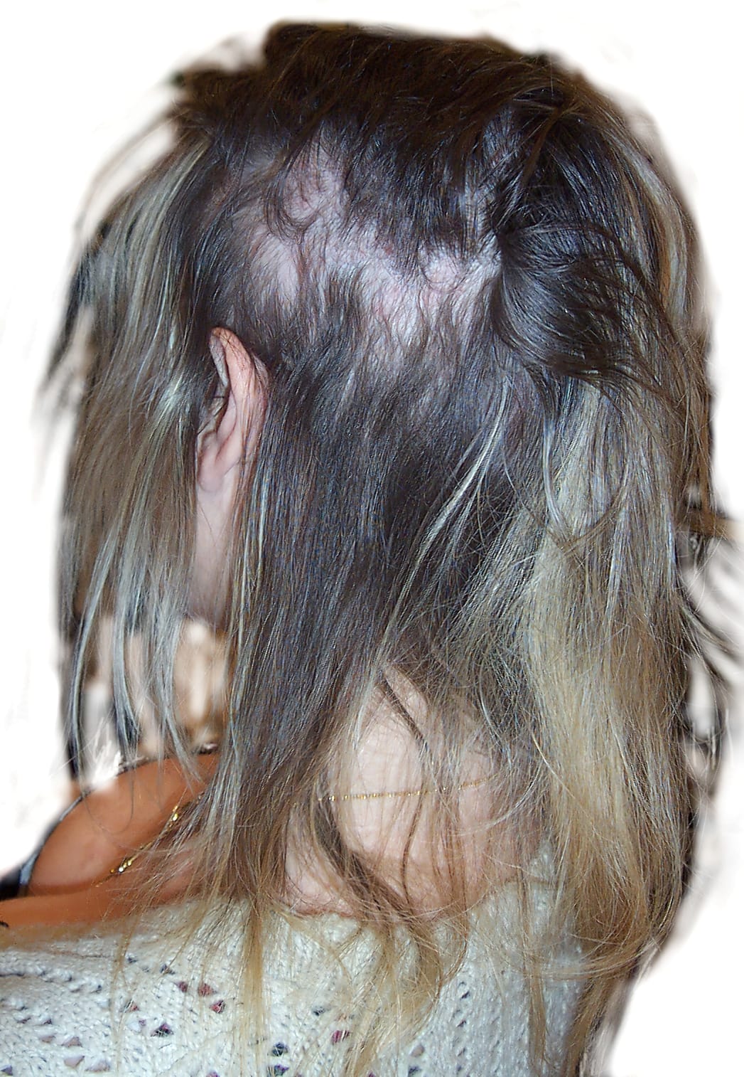 Before Picture - Human Hair Extension Damage Turnaround